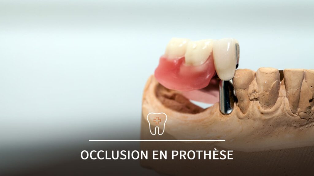 Modèle dentaire en résine avec prothèse amovible en cours d’ajustement, illustrant la gestion de l’occlusion prothétique.