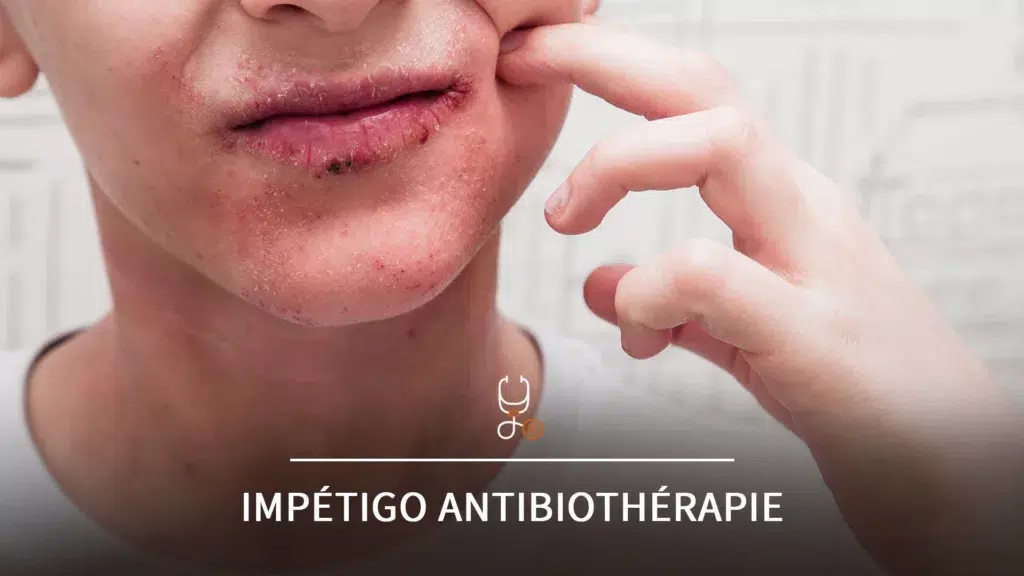 Gros plan sur le visage d’un patient présentant un impétigo autour de la bouche, illustrant la formation sur l’audit du bon usage de l’antibiothérapie.